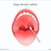 Gag throat reflex illustration