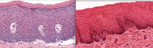 Keratinized vs non-keratinized epithelium