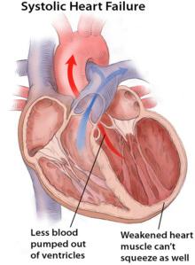 Systolic heart failure: less blood pumped out of ventricles, weakened heart muscle can't squeeze as well