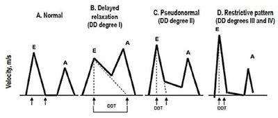 Patterns of diastolic dysfunction on Doppler echocardiography