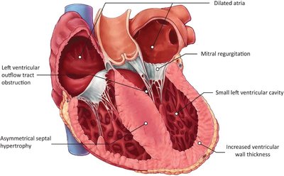 Gross pathology of hypertrophic cardiomyopathy