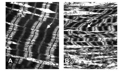Disrupted M bands in HCM