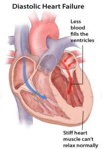 Diastolic heart failure: less blood fills the ventricles, stiff heart muscle can't relax normally
