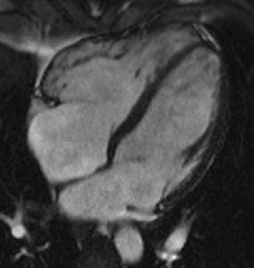 Echocardiographic comparison: normal vs HCM