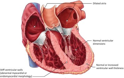 Gross pathology of restrictive cardiomyopathy