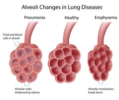 Alveolar changes in pneumonia and emphysema