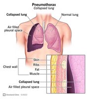 Clinical illustration of pneumothorax
