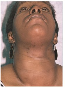 Goiter and myxedema