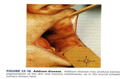 Addison disease with excess pigmentation
