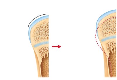Appositional growth and bone remodeling