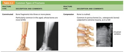 Common types of fractures: comminuted and compression