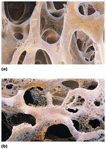 Normal vs. osteoporotic bone structure