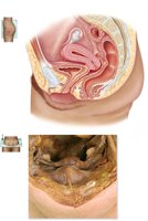 Fornix of the vagina