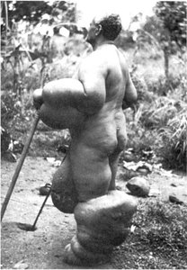A person with severe swelling of the limbs due to elephantiasis