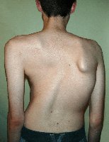 Clinical image of scoliosis (lateral spinal curvature)