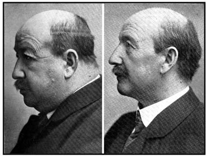 Before and after treatment of myxedema