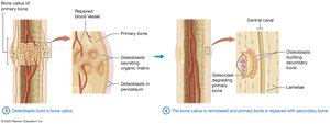 Fracture repair steps 3-4