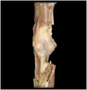 Dissected elbow joint