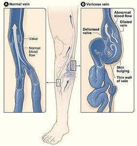 Diagram of normal and varicose veins