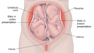 Vertex and breech presentation of babies in the uterus