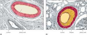Normal and Atherosclerotic Arteries
