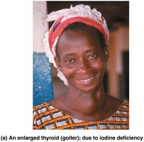 An enlarged thyroid (goiter) due to iodine deficiency