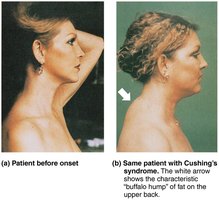 Effects of excess glucocorticoid (Cushing's syndrome)
