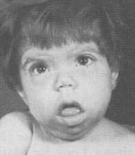 Clinical appearance of congenital hypothyroidism