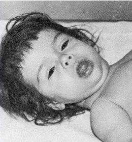 Clinical appearance of congenital hypothyroidism (side view)