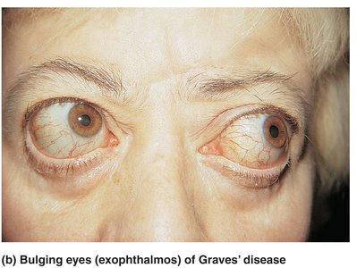 Bulging eyes (exophthalmos) of Graves' disease