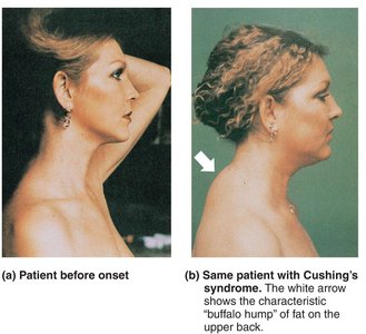 Cushing's syndrome: buffalo hump