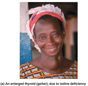 Enlarged thyroid (goiter) due to iodine deficiency