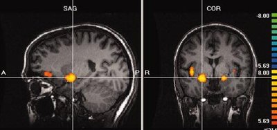 Functional MRI showing brain activation in response to olfactory stimuli