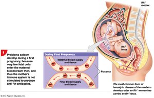 HDN: first pregnancy, Rh+ fetus and Rh− mother