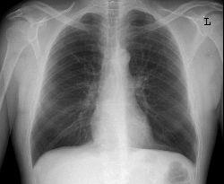 Chest x-ray showing heart and lungs