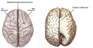 Cerebral hemispheres and corpus callosum