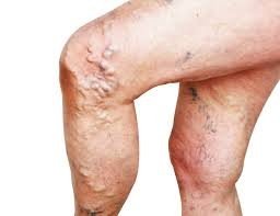 Varicose veins in the lower limb