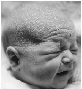 Cradle cap (seborrhea) in a newborn