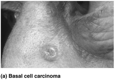 Basal cell carcinoma