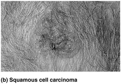 Squamous cell carcinoma