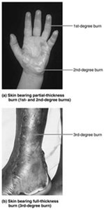 Partial-thickness and full-thickness burns