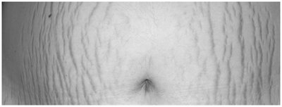 Photograph of stretch marks (striae)