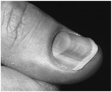 Photograph of koilonychia (spoon nail)