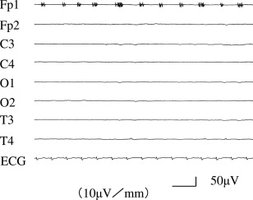 Flat EEG in brain death