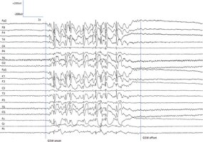 EEG pattern during epileptic seizure
