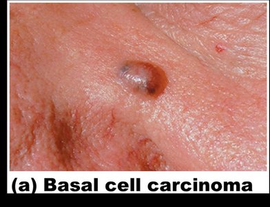 Basal cell carcinoma