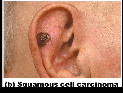 Squamous cell carcinoma