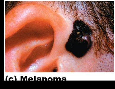 Malignant melanoma