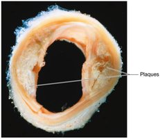Arterial cross-section showing atherosclerotic plaque
