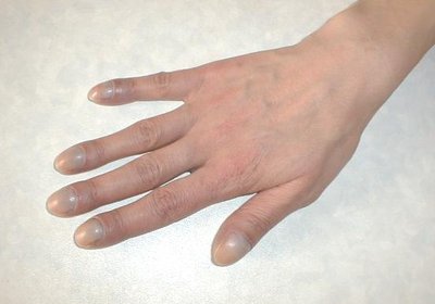 Cyanosis: bluish discoloration due to hypoxia